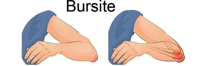 Bursite no ombro sintomas