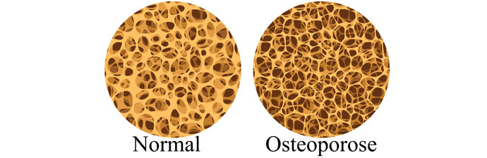 Osso Normal x Osso com Osteoporose