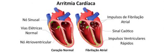 Arritmia-cardiaca - Blog Educação Física